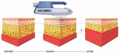 Emscuplt Neo how it works