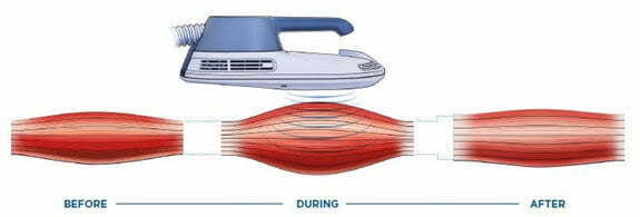 Emsculpt How It Works